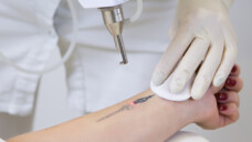 Vorsicht: In einer Studie stieg bei Personen, die sich ihr Tattoo mit Laserbehandlung entfernen ließen, das Lymphomrisiko&nbsp;drastisch an.&nbsp;(Foto: uv_group / AdobeStock)