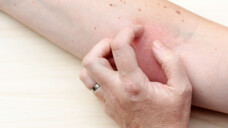 Verursachen Antihypertensiva Ekzeme? Eine Studie findet zumindest ein gehäuftes Auftreten der Hautreaktion bei Patienten mit Bluthochdruck. (Foto: Astrid Gast/AdobeStock)