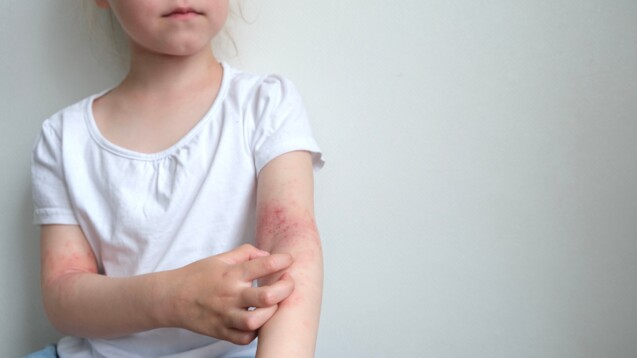 Entzugsreaktionen treten bei Kindern bereits nach einem zweimonatigen Gebrauch topischer Glucocorticoide auf. (Foto: Марина Терехова / AdobeStock)