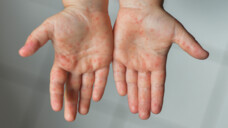 Die Hand-Fuß-Mund-Krankheit ist die bekannteste Infektionskrankheit, die durch Coxsackie-Viren verursacht wird. Doch die Viren können viele andere Krankheitsbilder auslösen. (Foto: o1559kip/AdobeStock)
