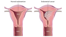 Die Standardbehandlung eines Endometriumkarzinoms ist die vollständige operative Entfernung der Gebärmutter.&nbsp;(Foto: rob3000 / AdobeStock)